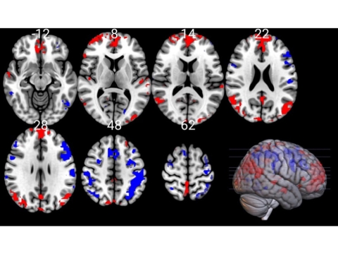 Layers of the MRI scan also showing increased activity in the medial prefrontal cortex and parietal cortex
